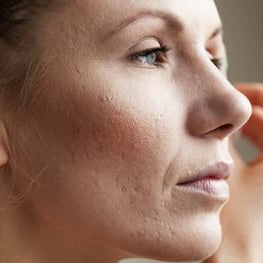 why are you breaking out?